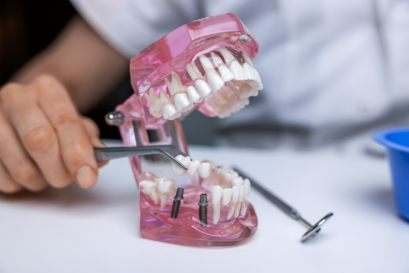 Have Multiple Missing Teeth? You Should Get Treated With Multiple ...